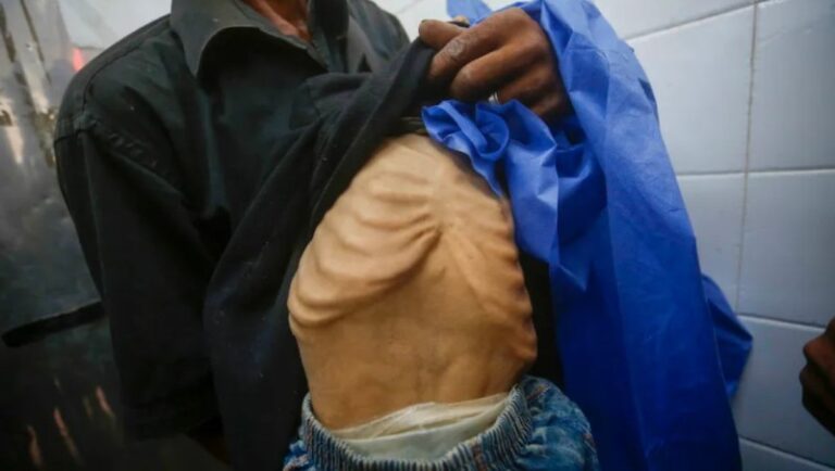 Kelaparan Rakyat Gaza Kian Mengerikan, WHO dan WFP Peringatkan Ambang Kehancuran Gizi